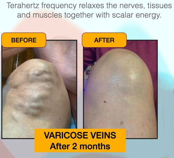 varicose veins